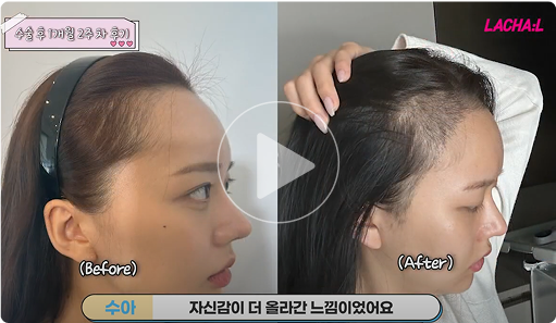 모모 수술상담 썸네일3