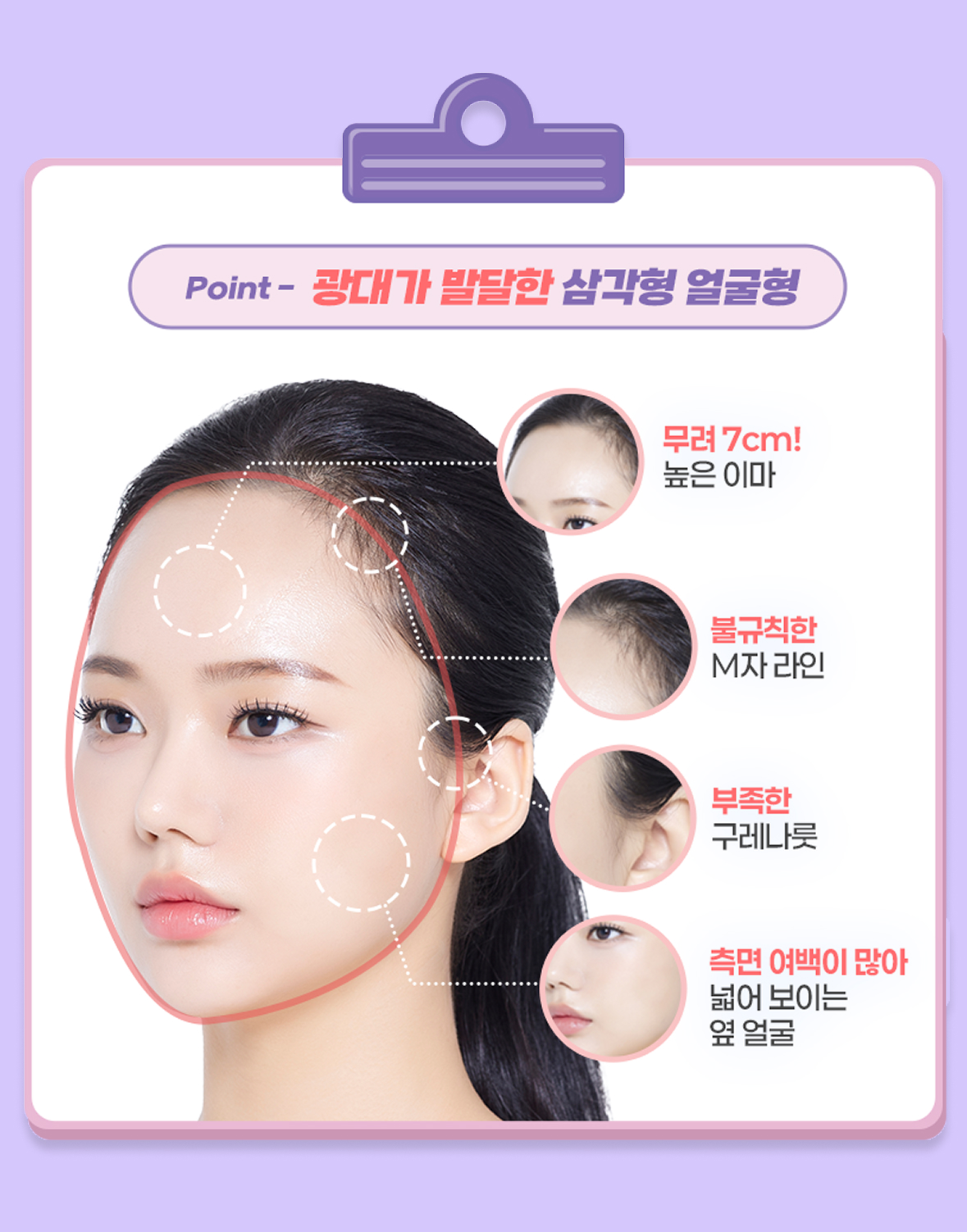 모발이식 진단 point