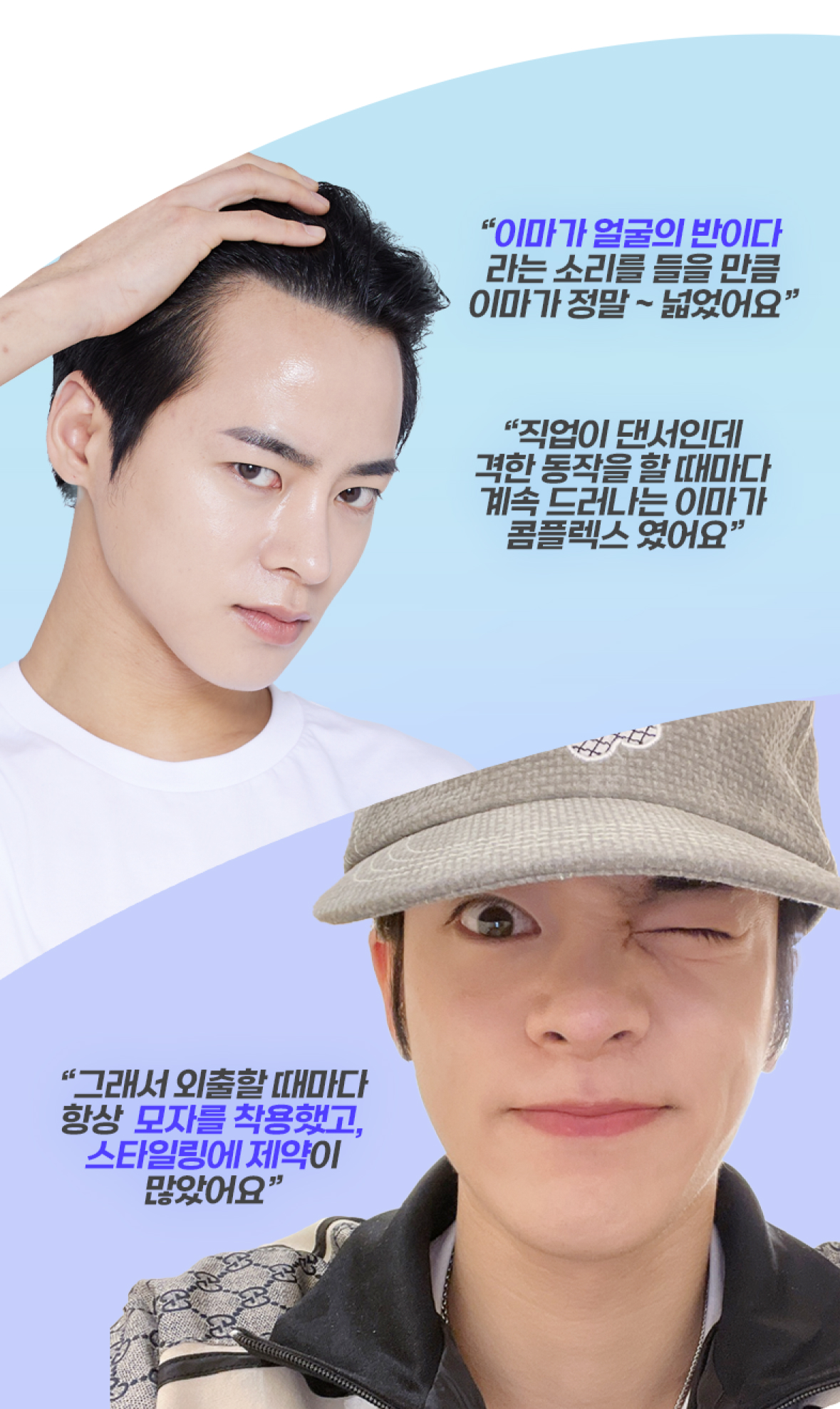 모발이식 필요성