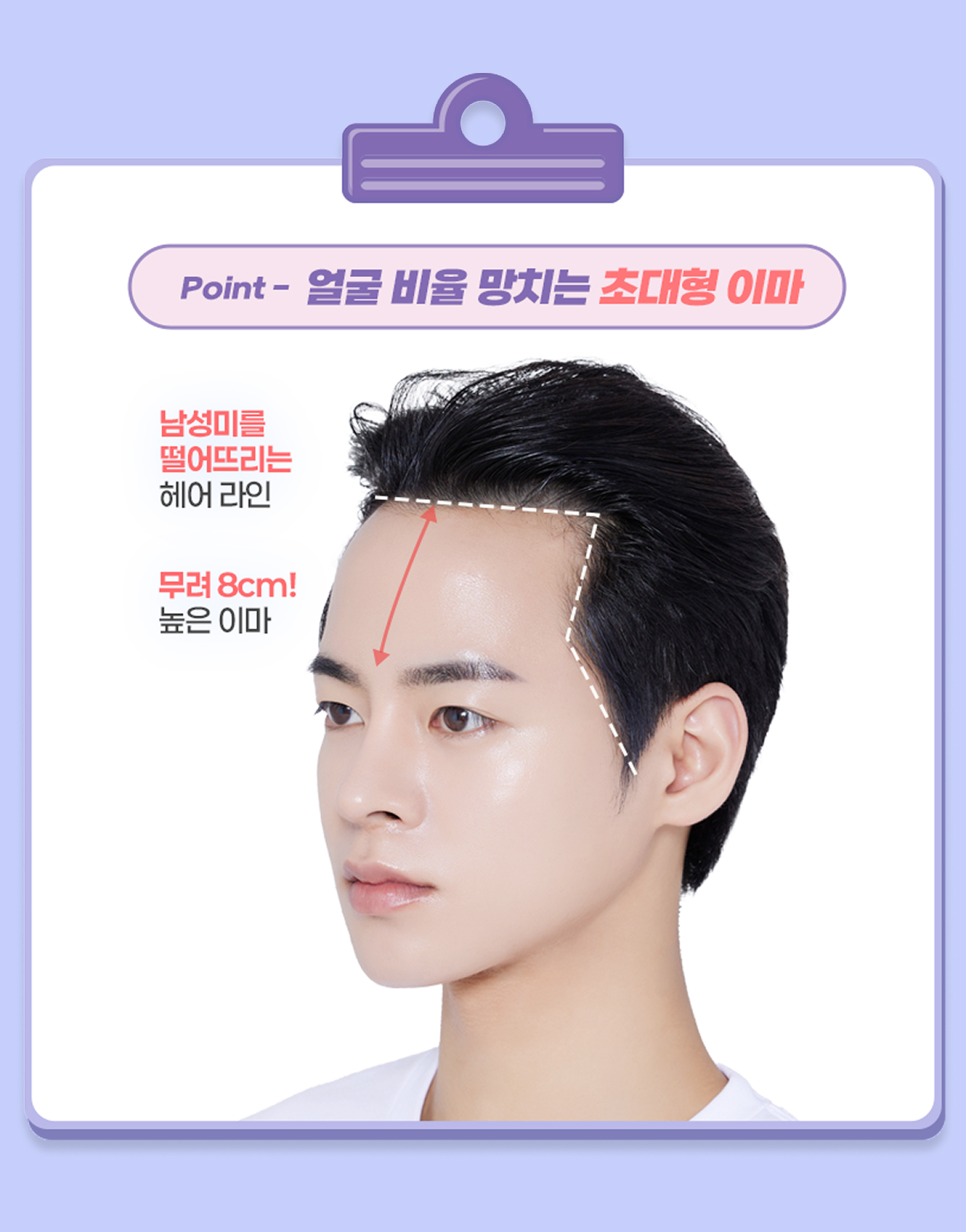 모발이식 진단 point