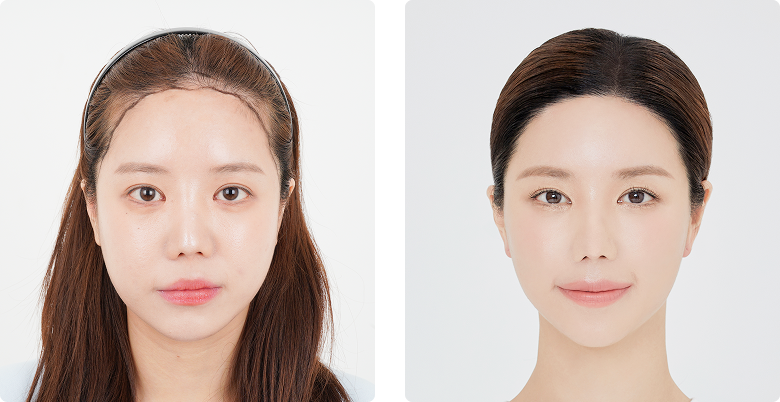 리얼포토후기 정면