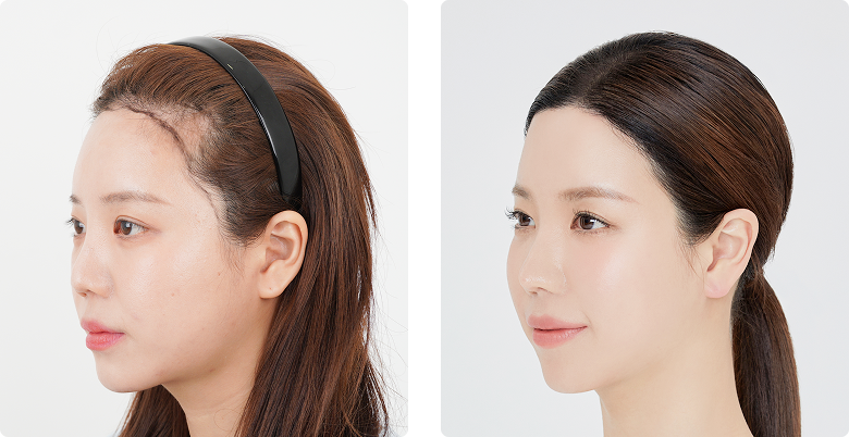 리얼포토후기 측면