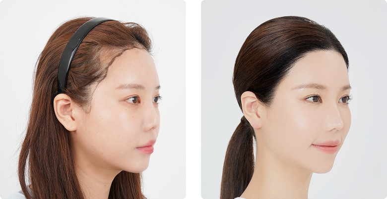 리얼포토후기 측면