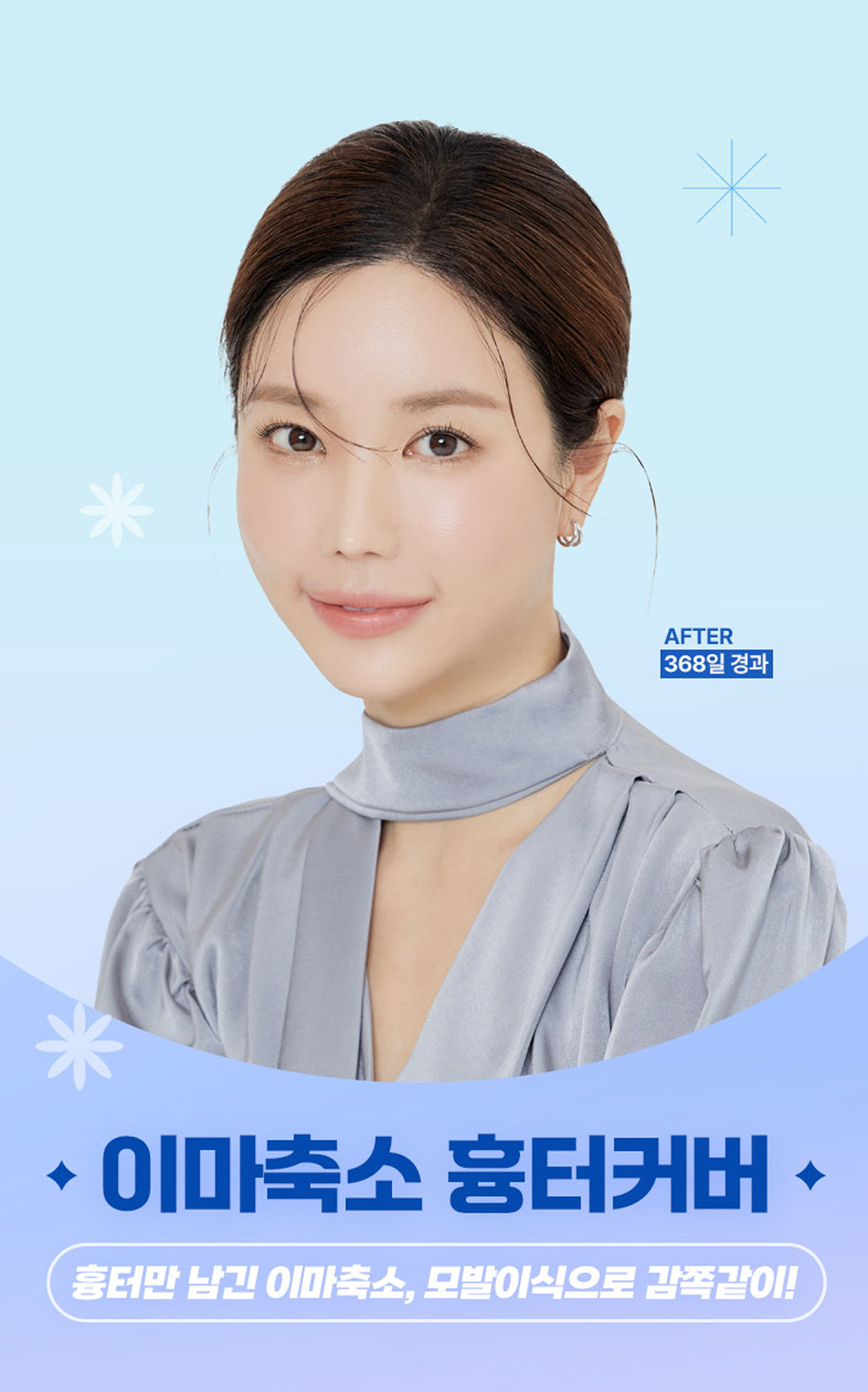 이마축소 흉터커버, 흉터만 남긴 이마축소, 모발이식으로 감쪽같이!