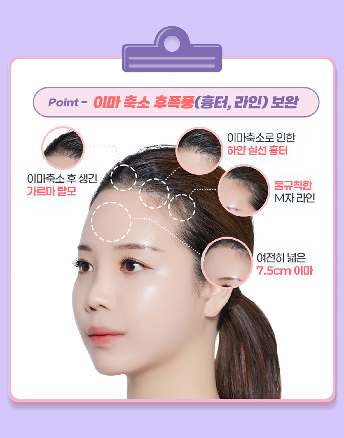 모발이식 진단 point