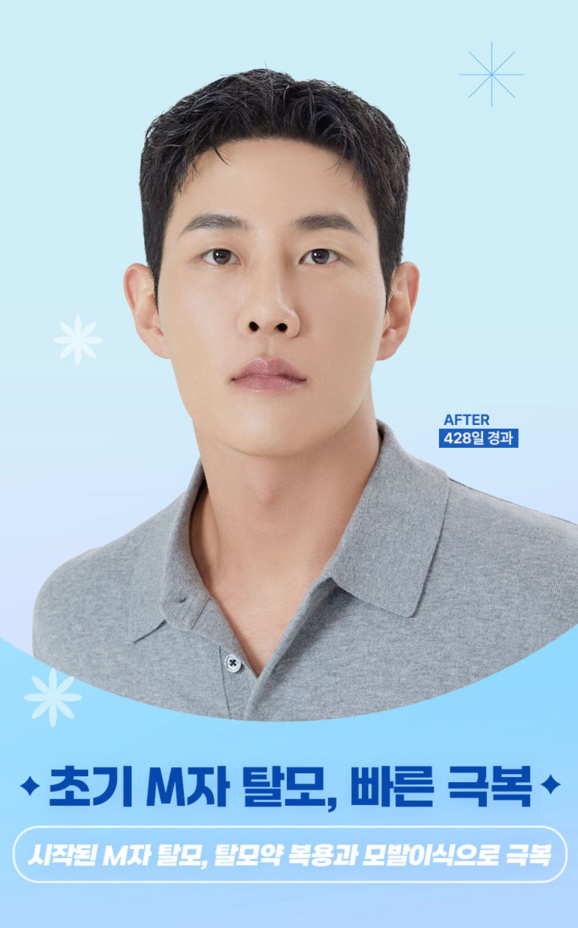 초기 M자 탈모, 빠른 극복, 시작된 M자 탈모, 탈모약 복용과 모발이식으로 극복