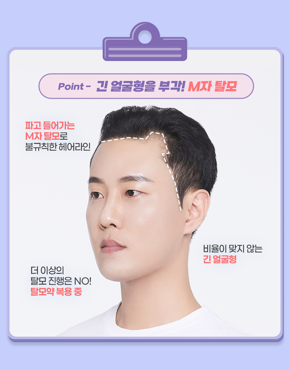 모발이식 진단 point