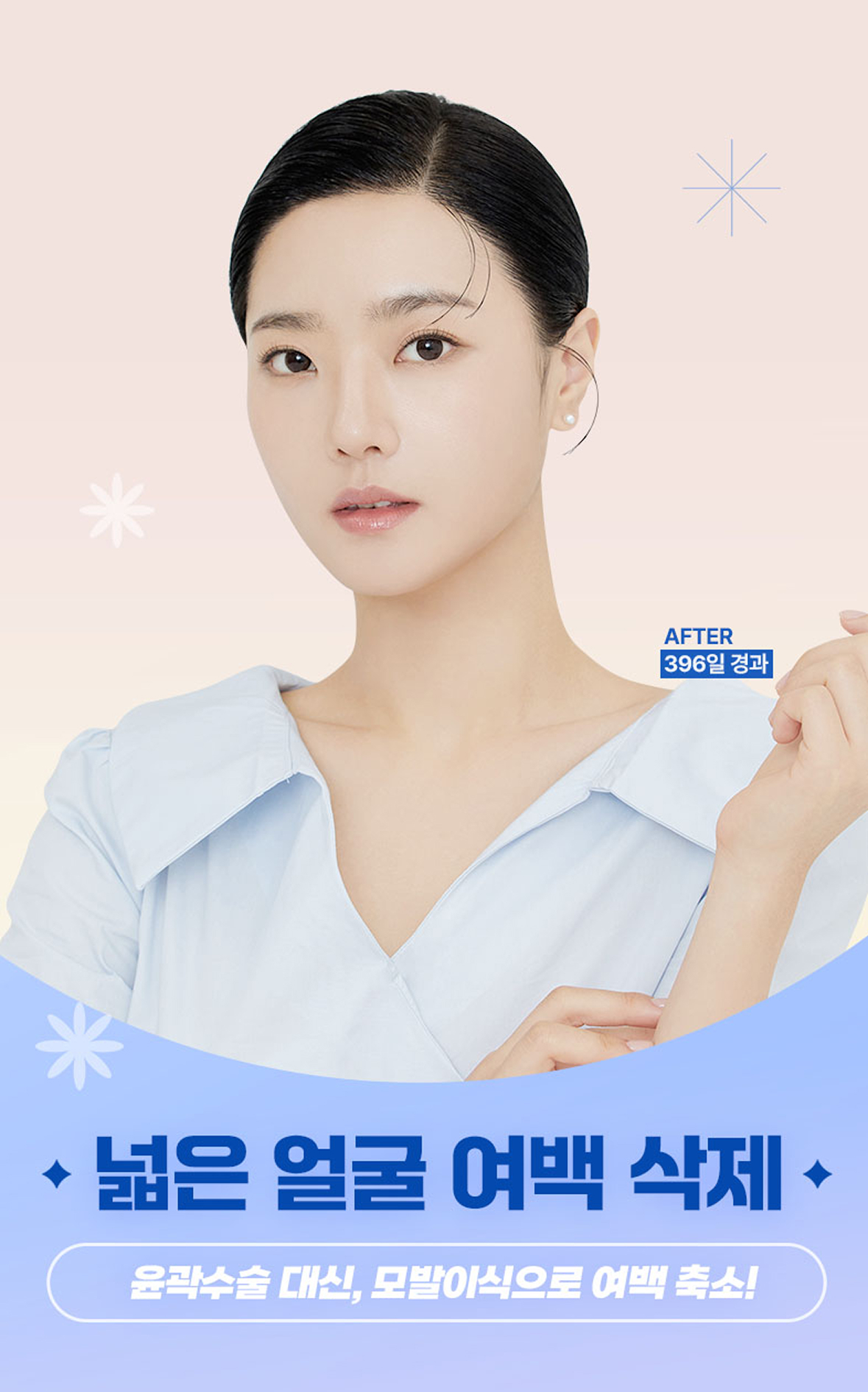 넓은 얼굴 여백 삭제! 윤곽수술  대신, 모발이식으로 여백 축소!