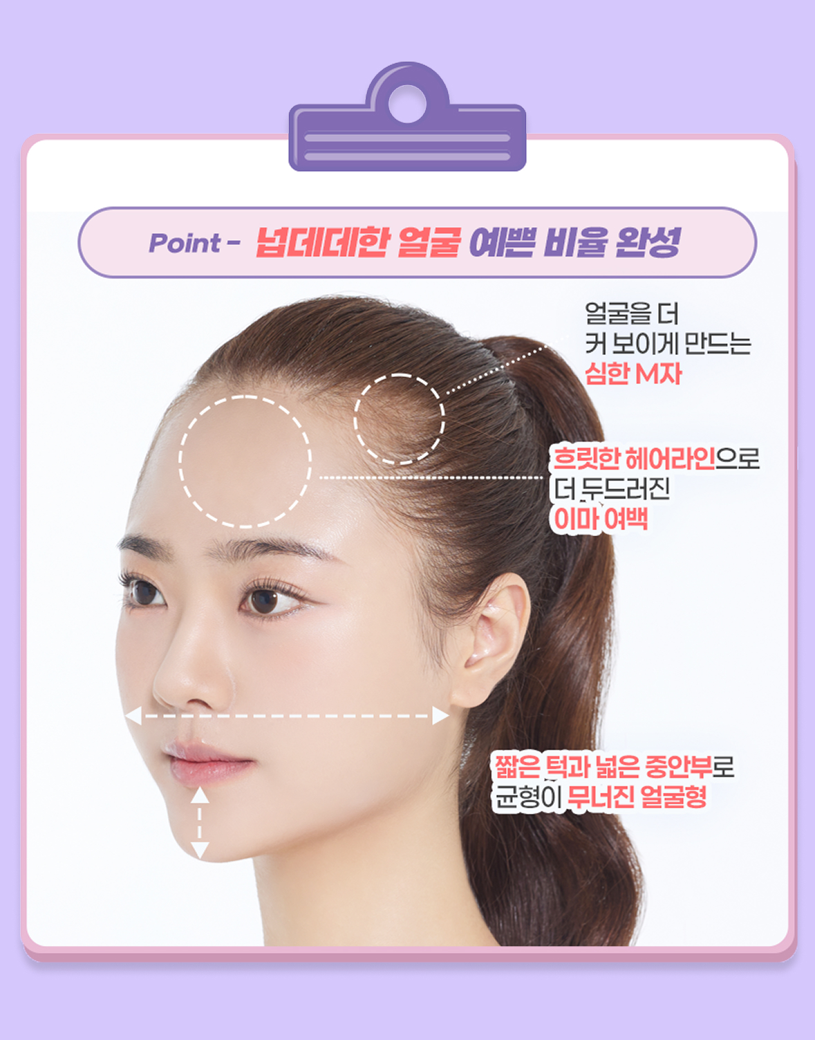 모발이식 진단 point