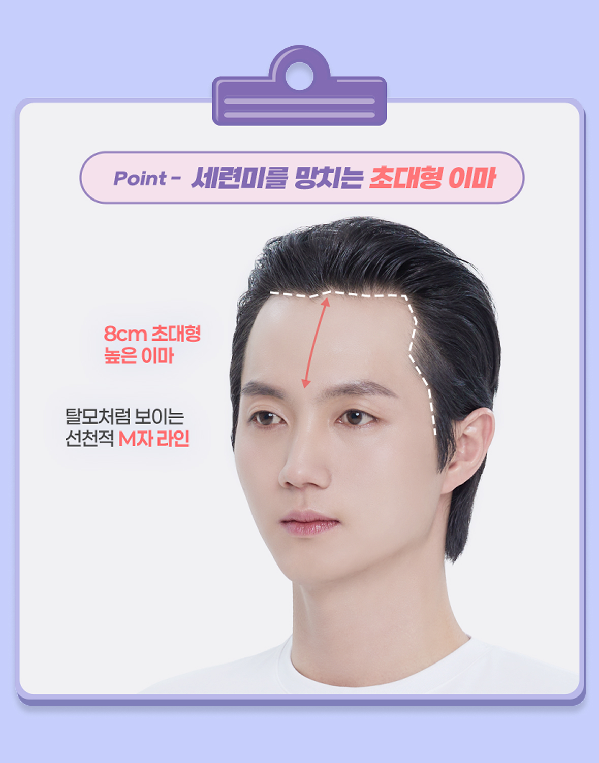 모발이식 진단 point