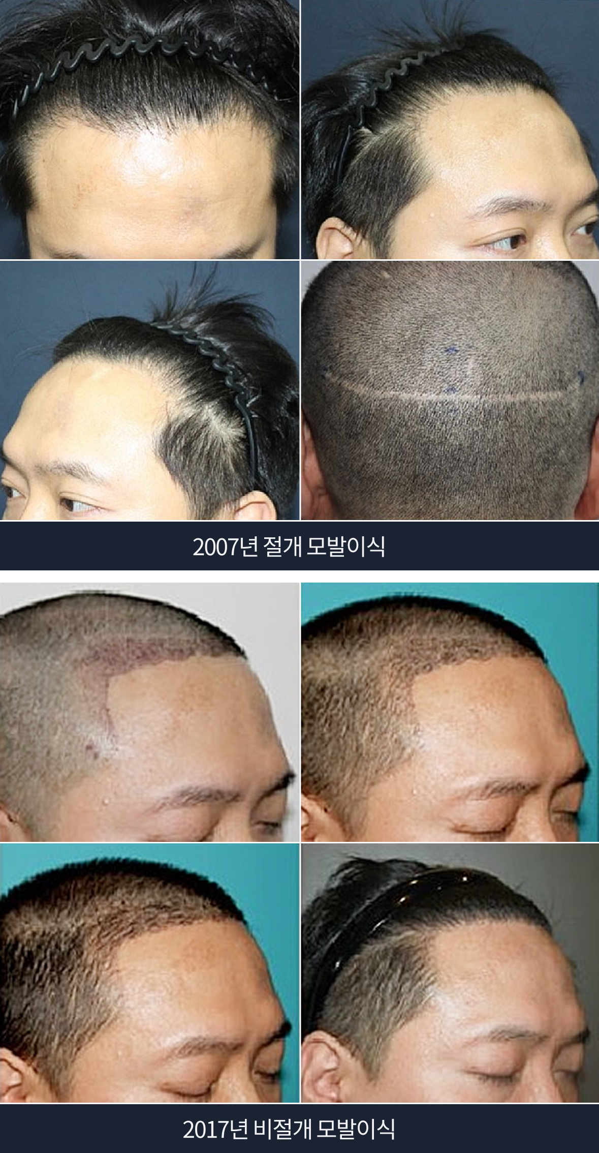 문효섭 대표원장 모발이식 스토리