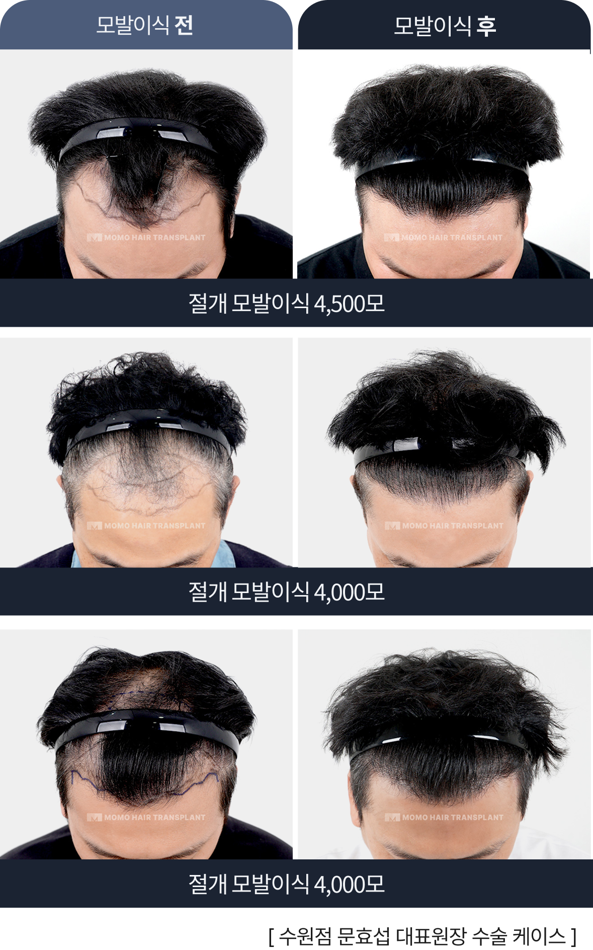 문효섭 대표원장 모발이식 스토리