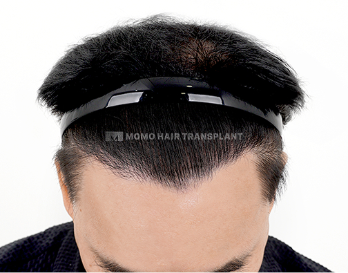 남성 절개 모발이식 after