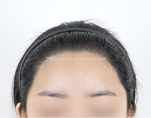 여성 절개 모발이식 after
