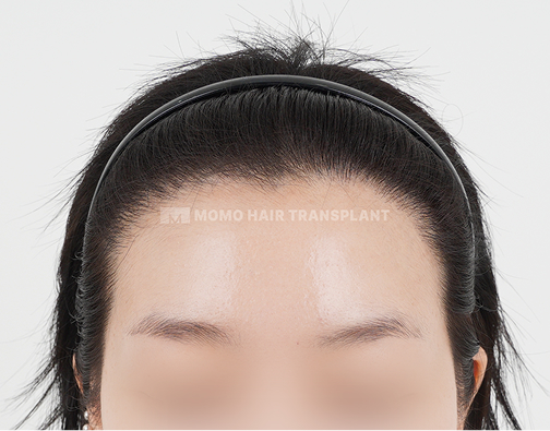 여성 절개 모발이식 after