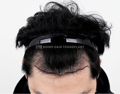 남성 절개 모발이식 before