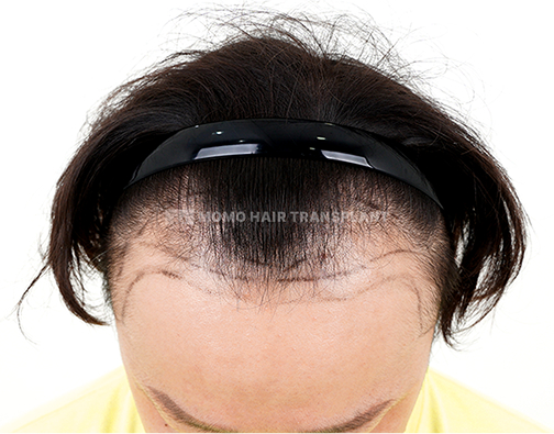 남성 절개 모발이식 before