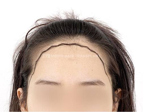 여성 절개 모발이식 before