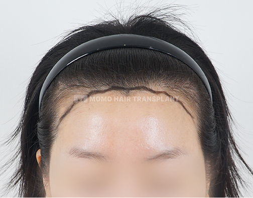 여성 절개 모발이식 before