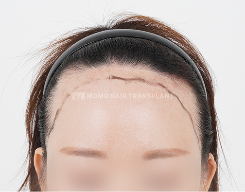 여성 절개 모발이식 before