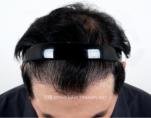 남성 비절개 모발이식 after