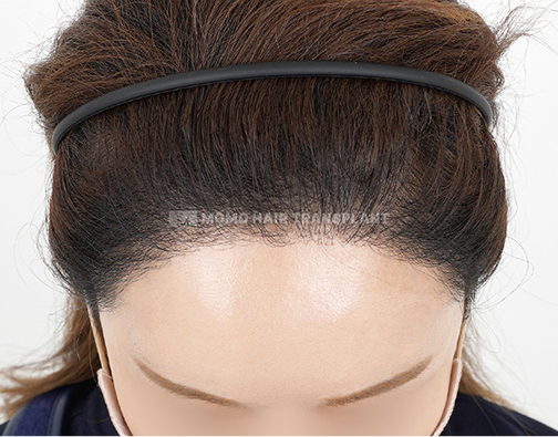 여성 비절개 모발이식 after