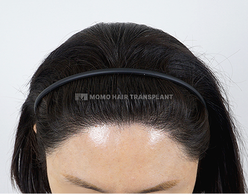 여성 비절개 모발이식 after