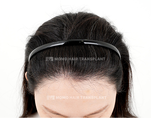 여성 비절개 모발이식 after