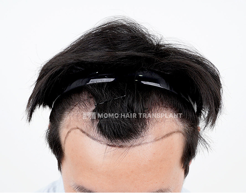 남성 비절개 모발이식 before