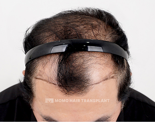 남성 비절개 모발이식 before