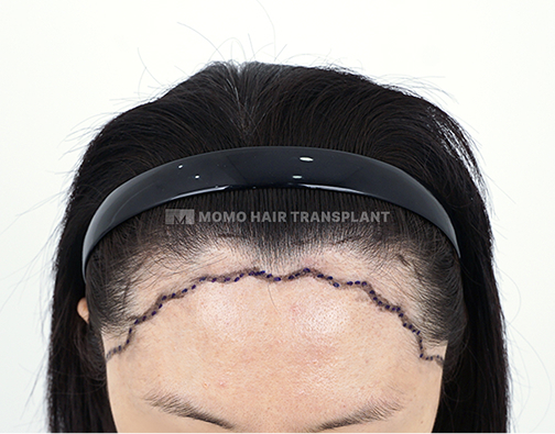 여성 비절개 모발이식 before