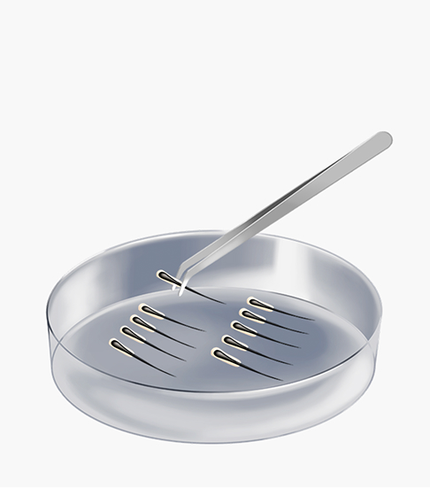 절개 모발이식 수술방법