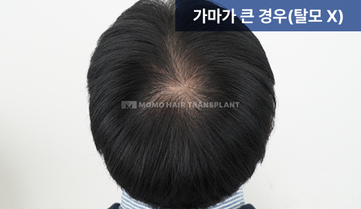 가마가 큰 경우(탈모X)