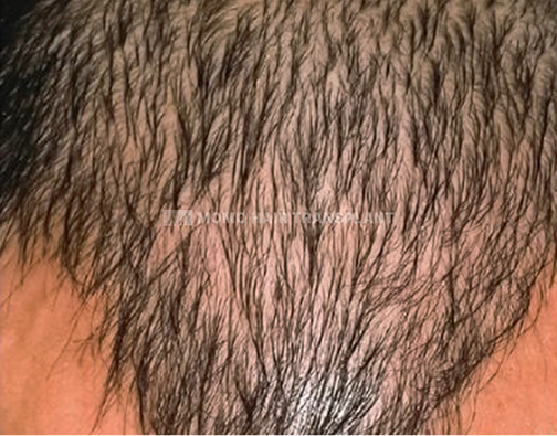 아타스iX 모발이식 before