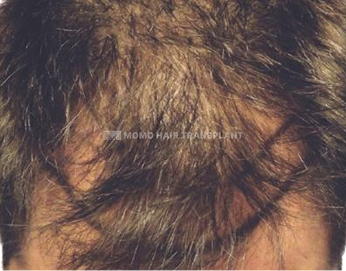 아타스iX 모발이식 before