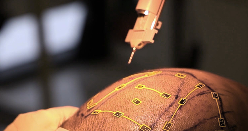 초정밀 수술 실현