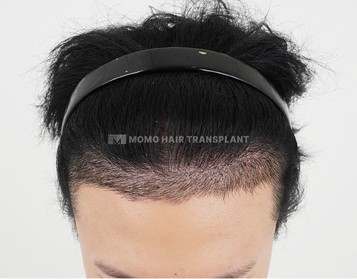남성 비절개 모발이식 after