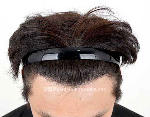남성 비절개 모발이식 after