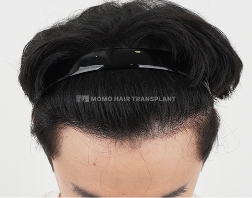 남성 비절개 모발이식 after