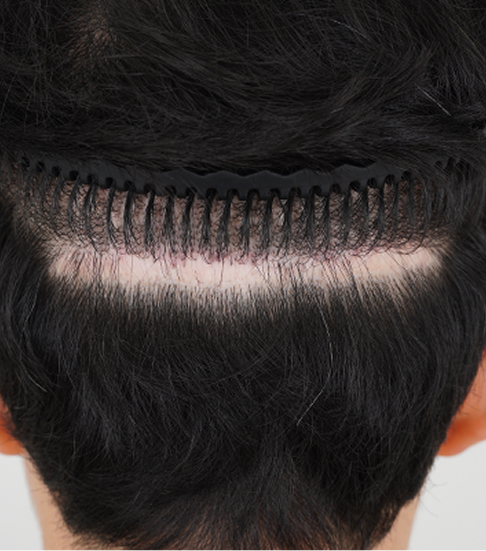 후두부의 피부변형