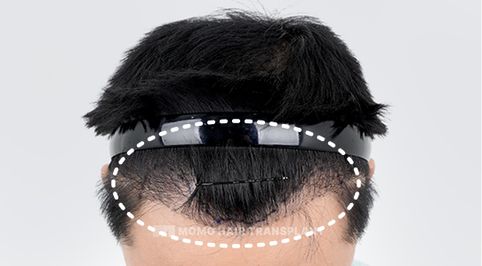 생착 실패로 인한 밀도 부족