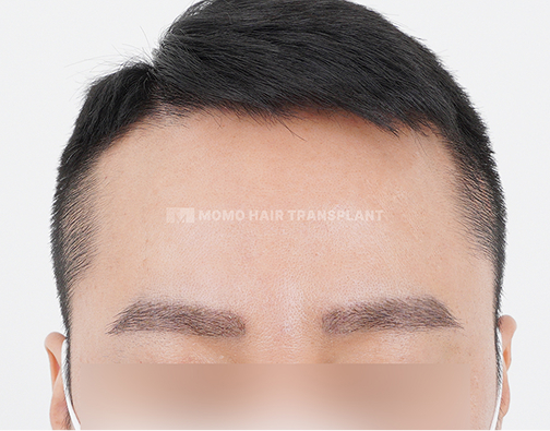눈썹 모발이식 after