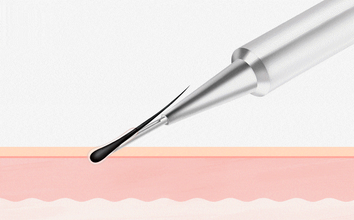 구레나룻 방향, 각도를 살린 이식 스킬