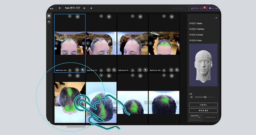 탈모 상황 분석