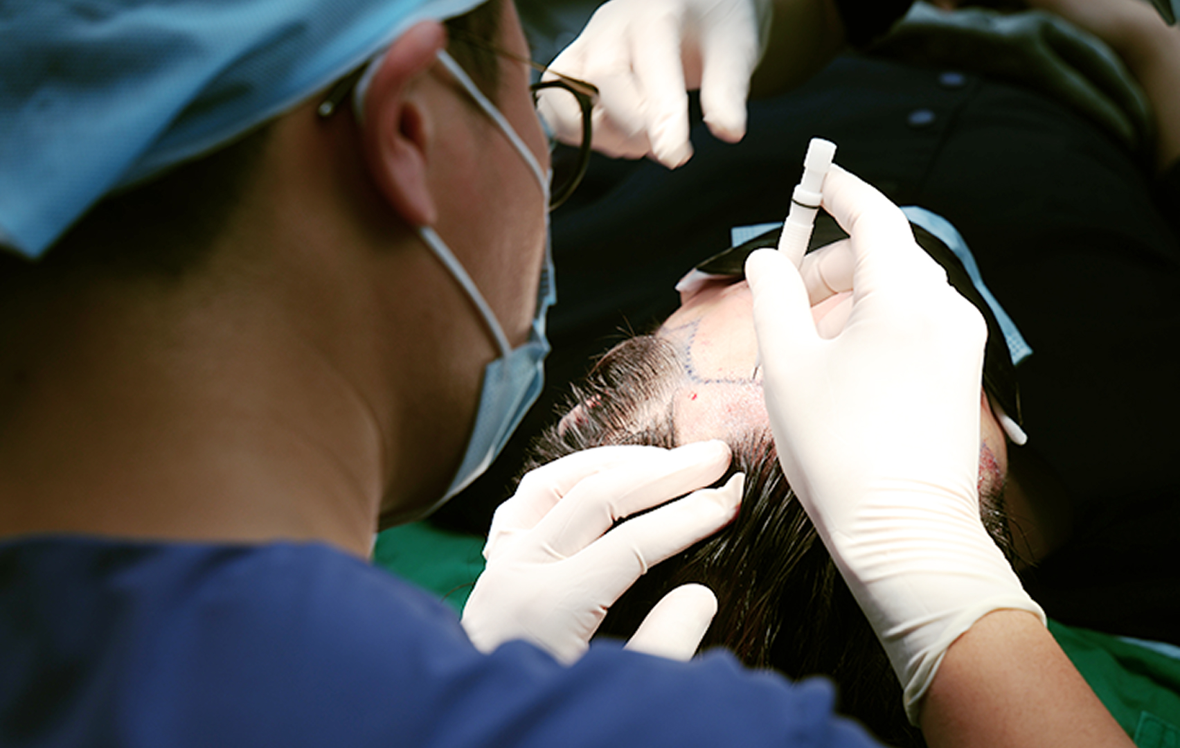 모발이식의 진행과정