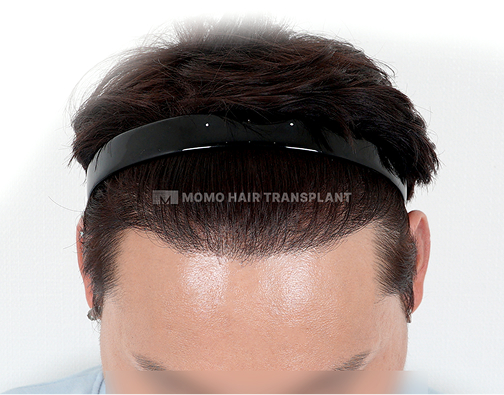 남성 절개 모발이식 after