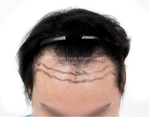 남성 절개 모발이식 before