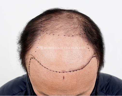 남성 절개 모발이식 before