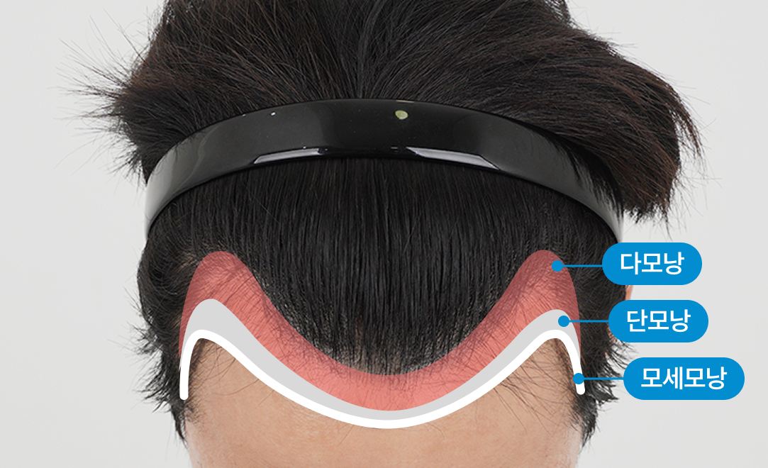 이마 그라데이션 이식