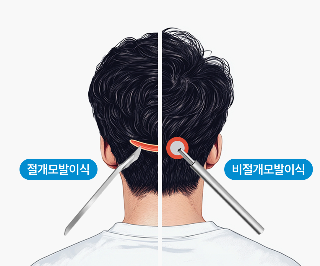 풍성한 혼용 모발이식 절개+비절개